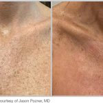 BBL Hero Before & After Results