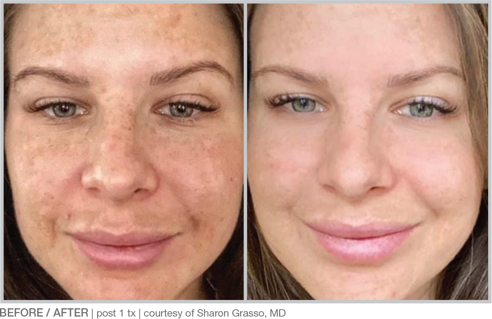BBL Hero Before & After Results