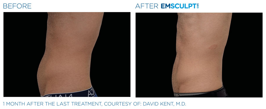 Emsculpt Neo Male Abdomen Before & After