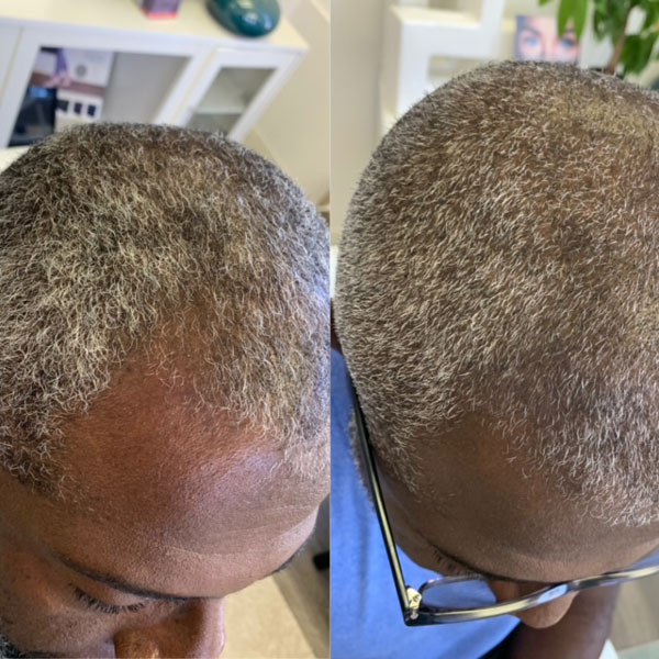 PRP Hair Restoration Before And After
