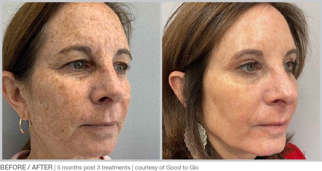 before-after-Photos-BBL-HERO_1