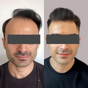 Hair Transplant Before and After Results