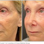 BBL Hero Before & After Results