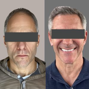 Hair Transplant Before and After Results