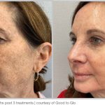 BBL Hero Before & After Results