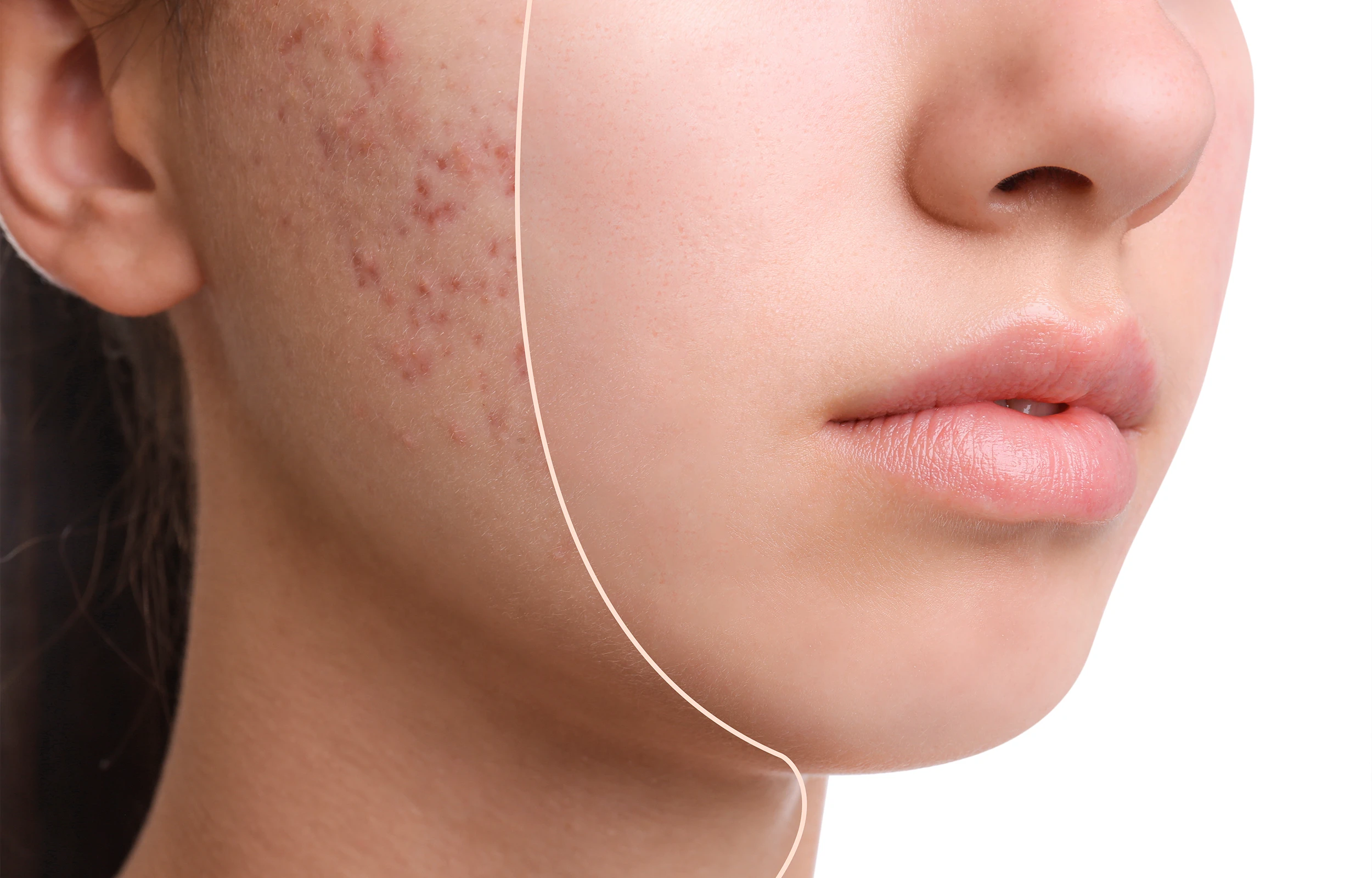 Acne Treatments