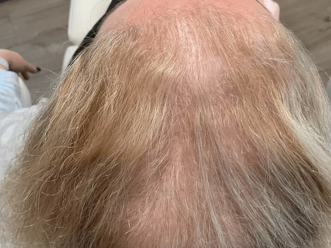Hair Loss