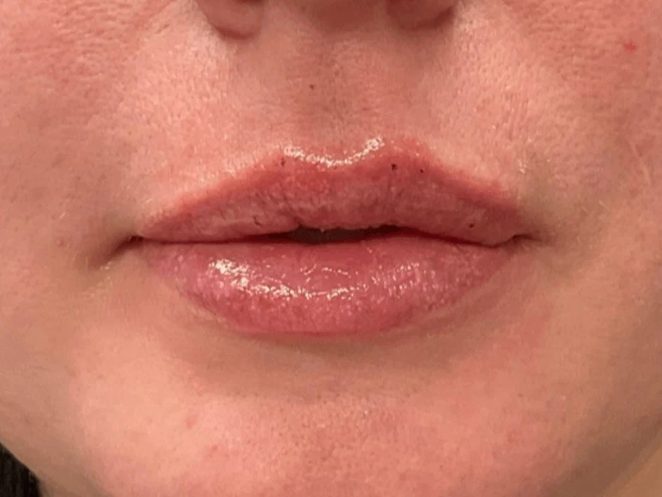 Lip Filler