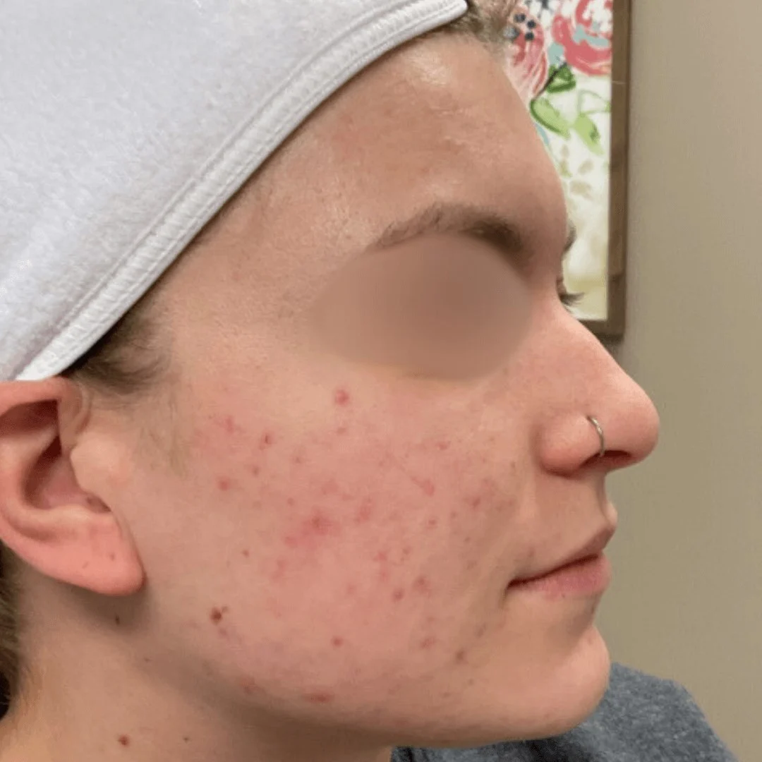 Acne Treatment 