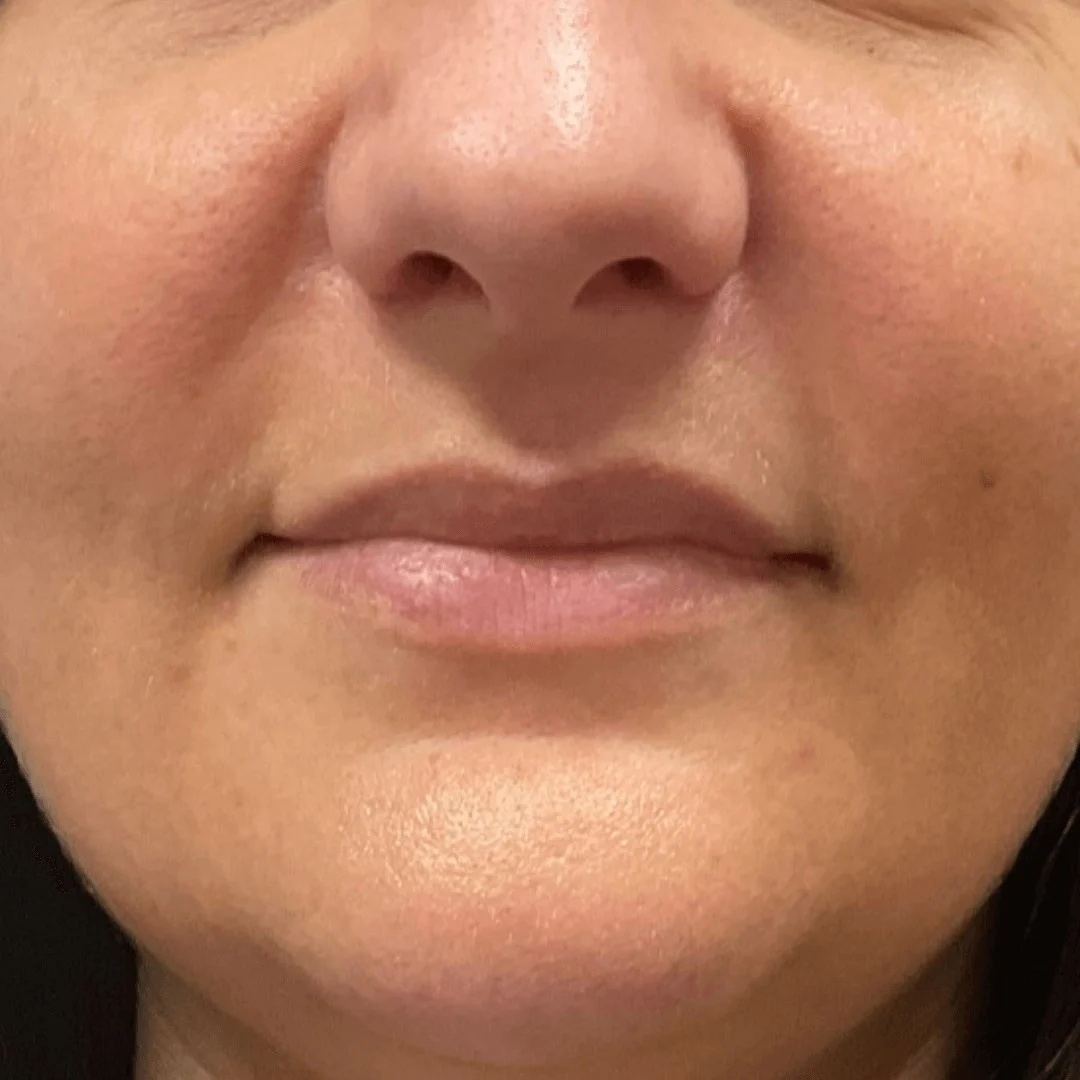  Lip Filler