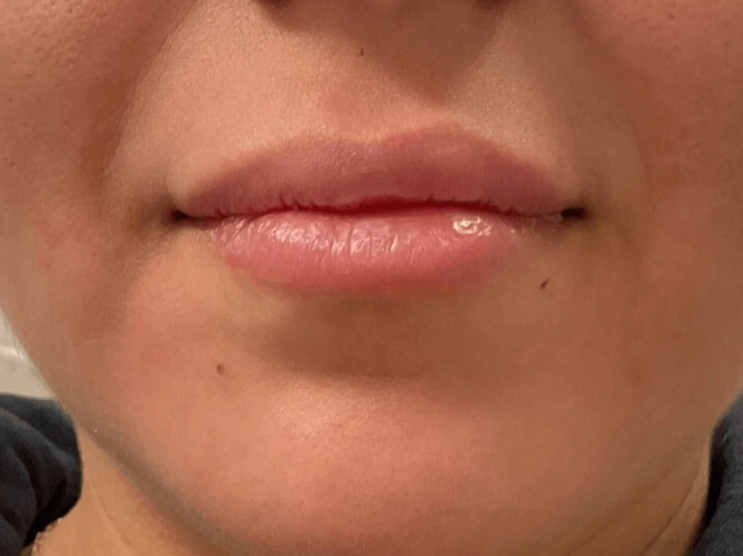 Lip Filler