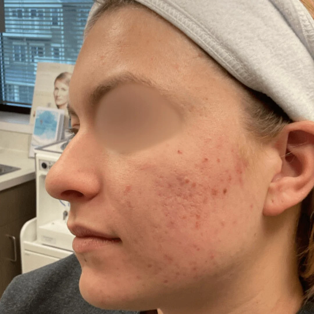 Acne Treatment 