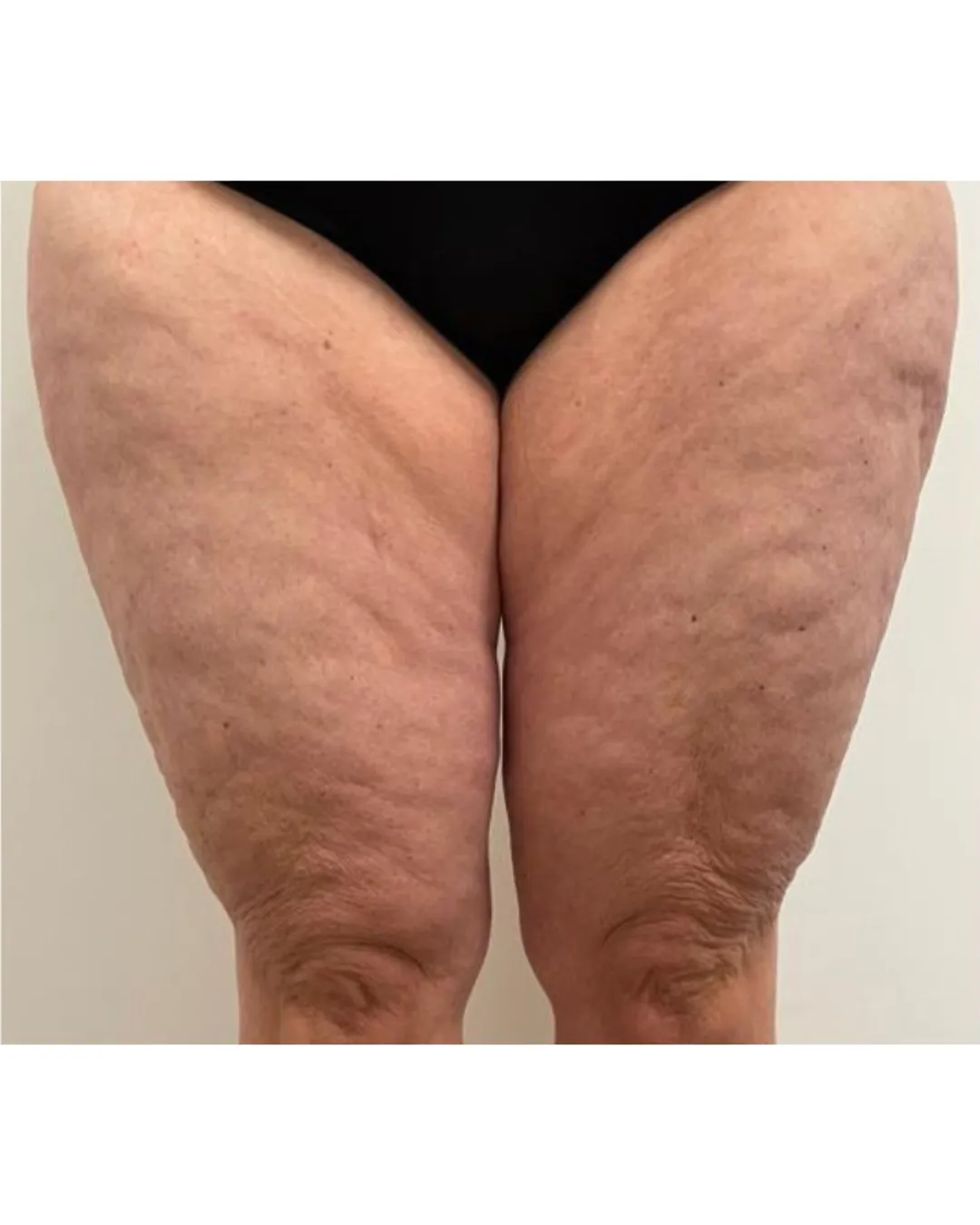 Cellulite Reduction