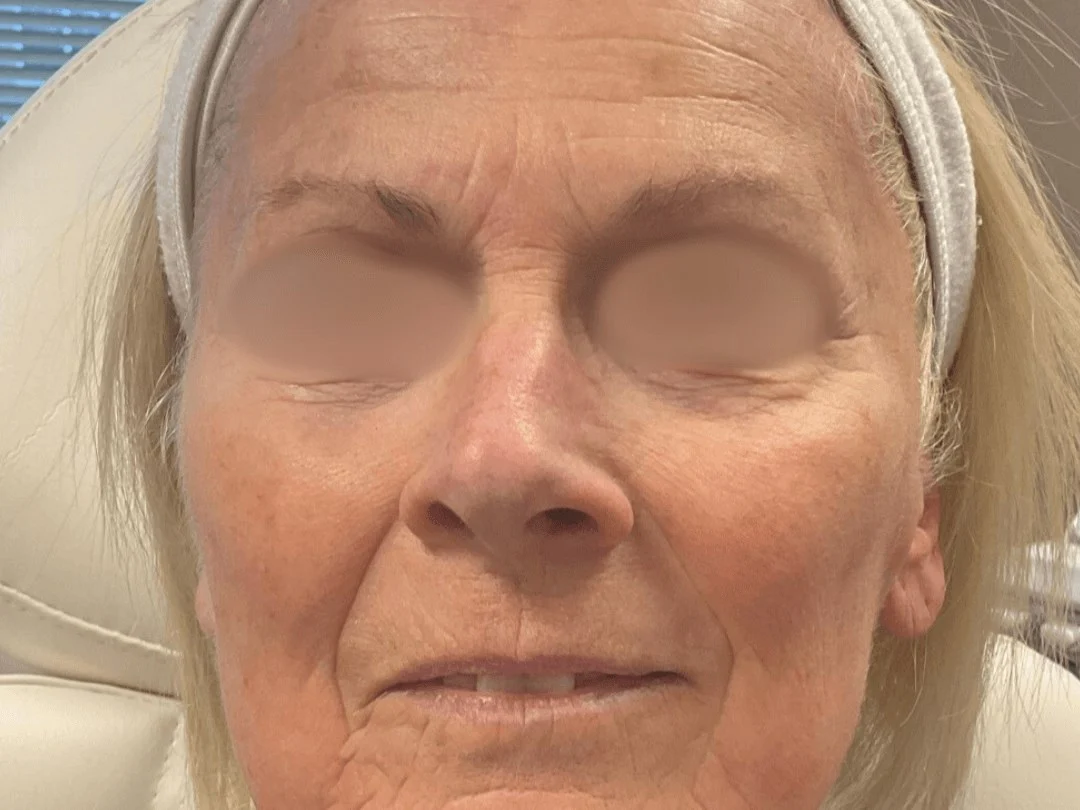 Skin Resurfacing