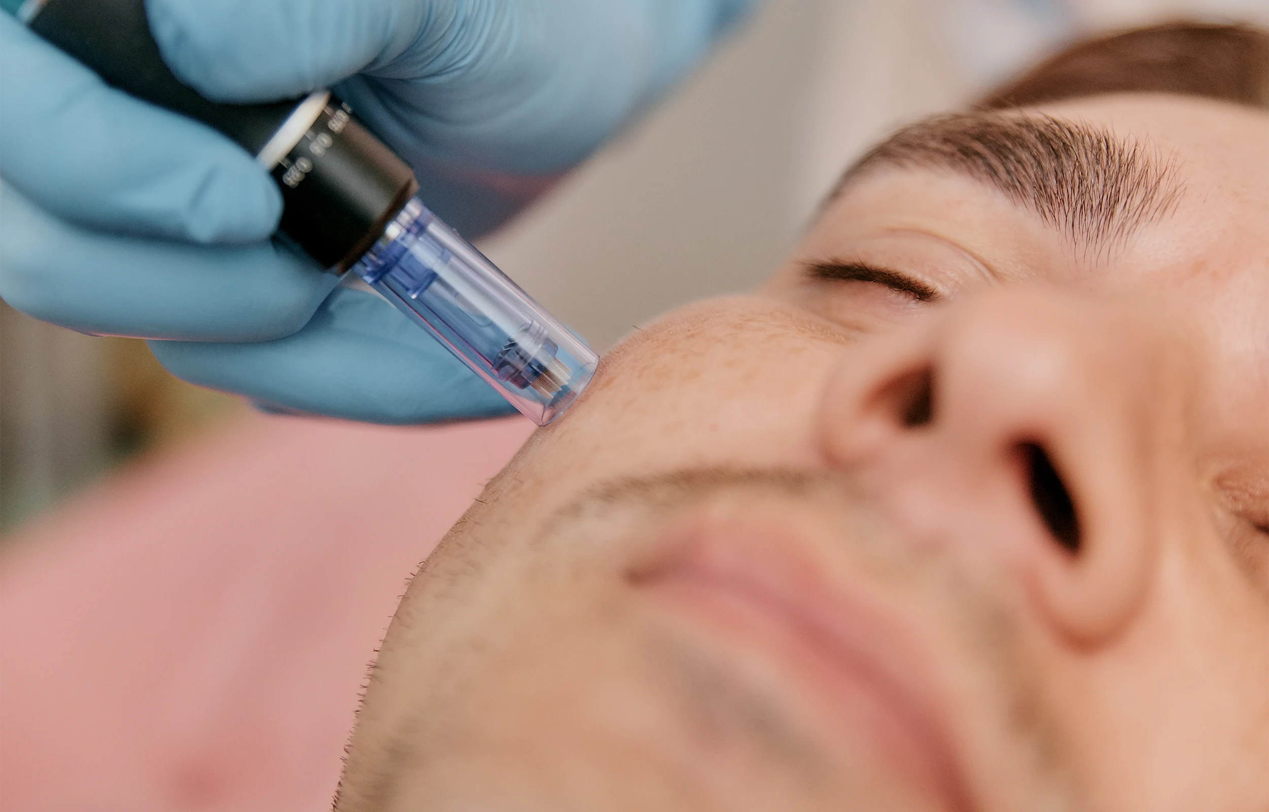 RF Microneedling