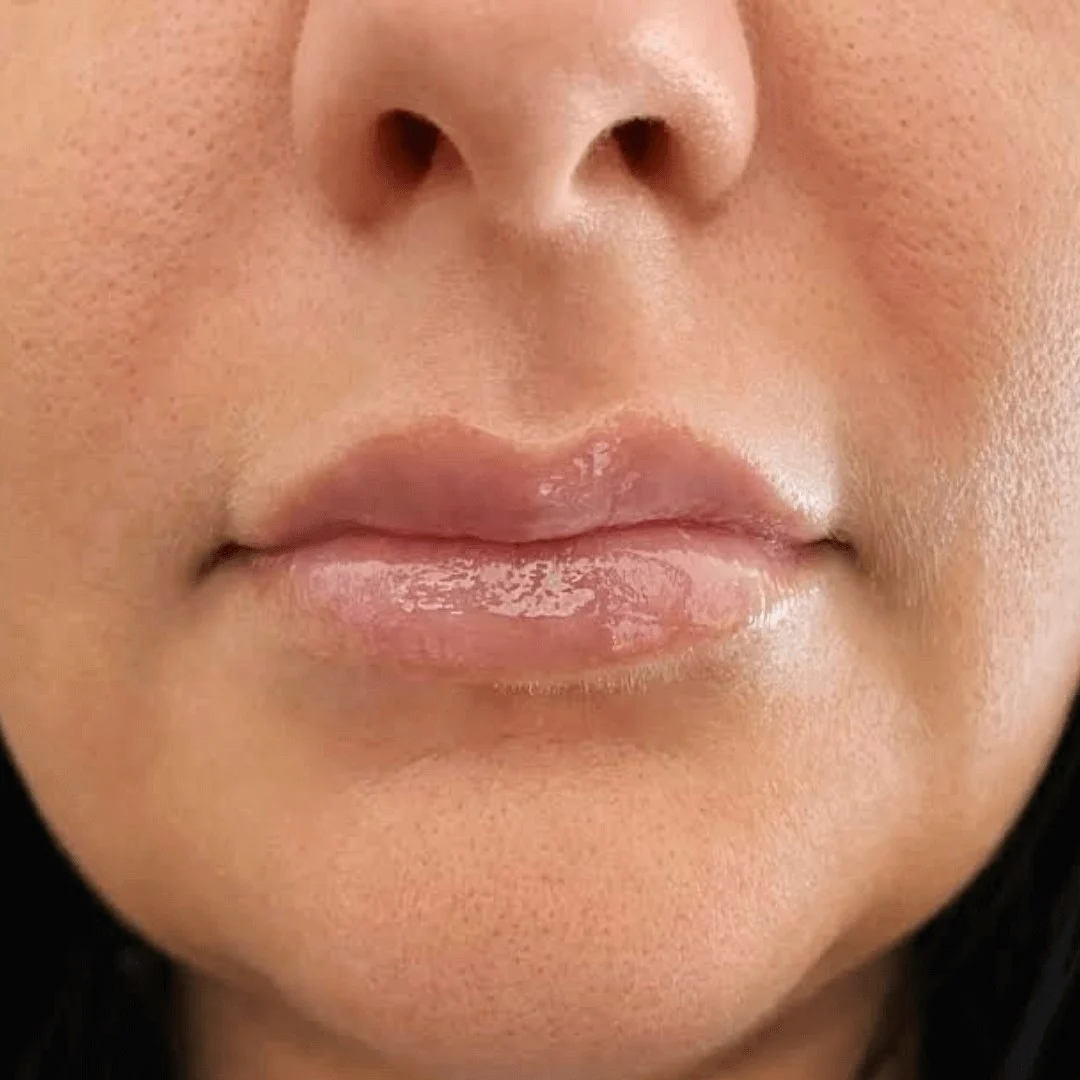  Lip Filler