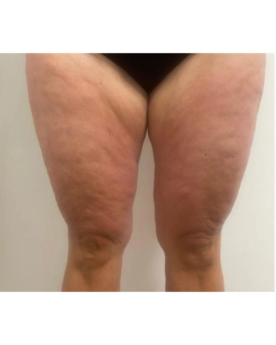 Cellulite Reduction