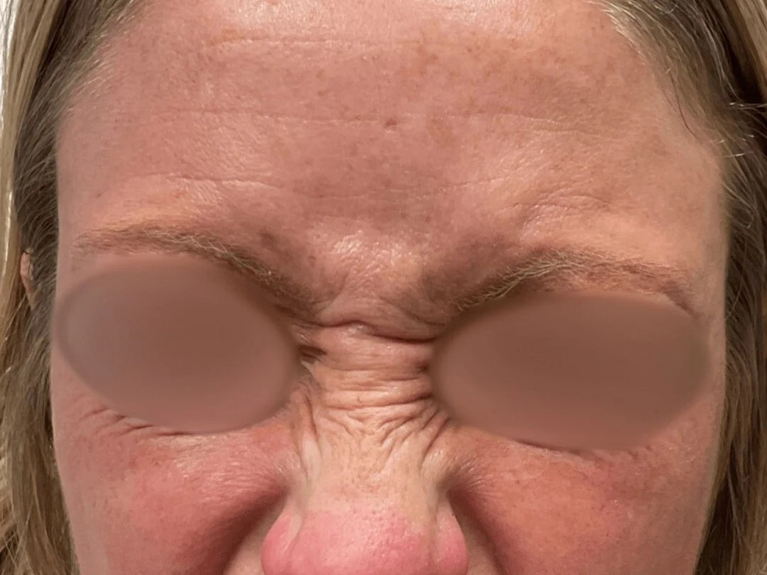 Wrinkle