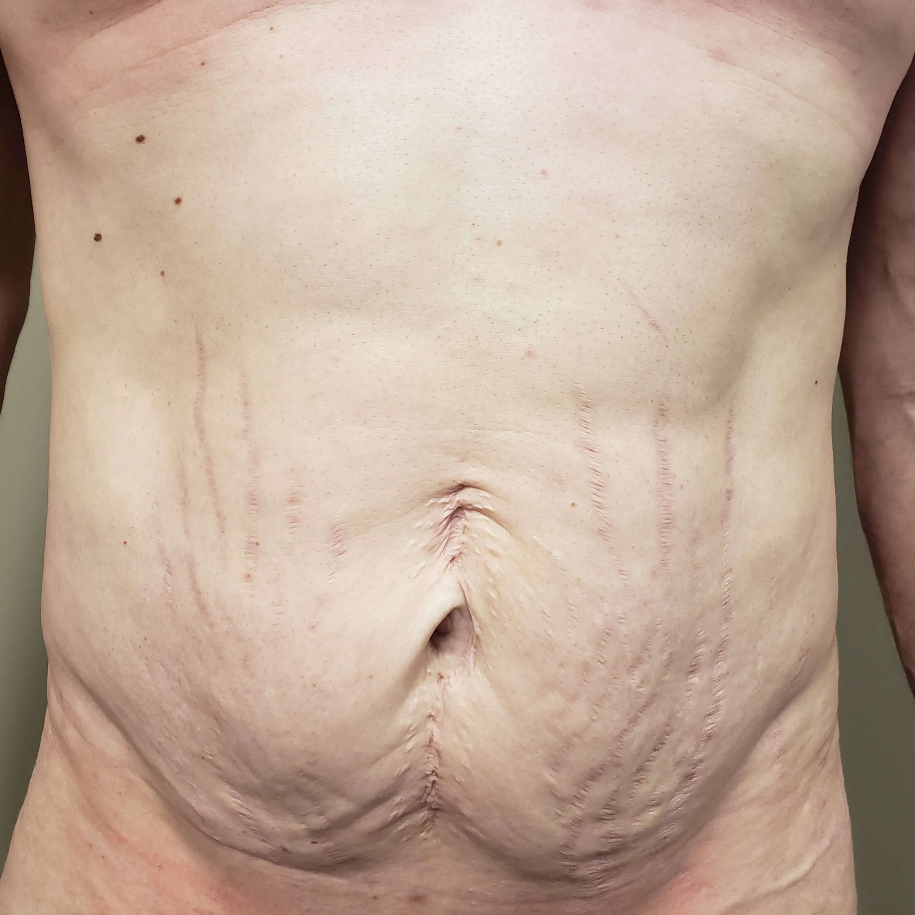 Body Contouring