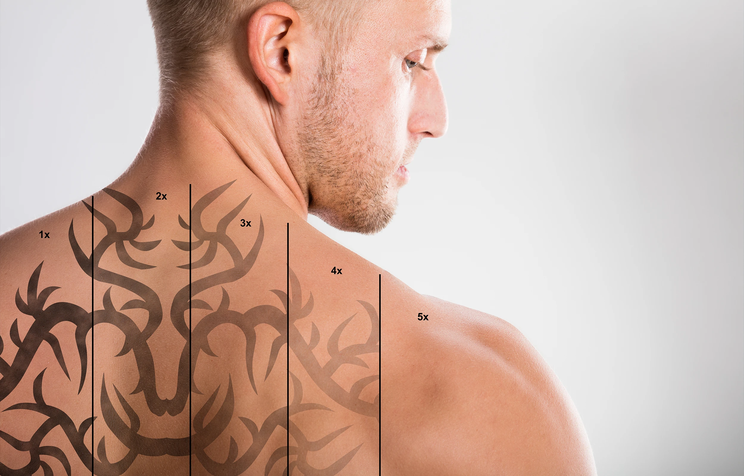 Tattoo and PMU Removal