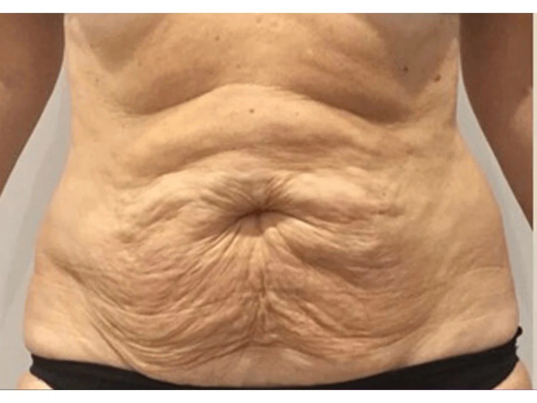 Body Contouring