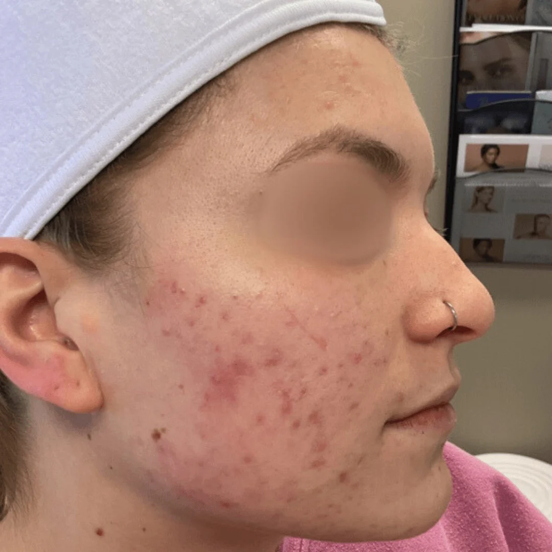 Acne Treatment 