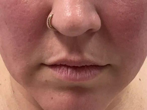  Lip Filler