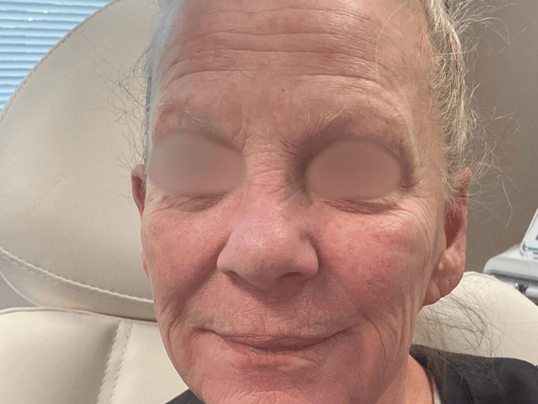 Skin Resurfacing