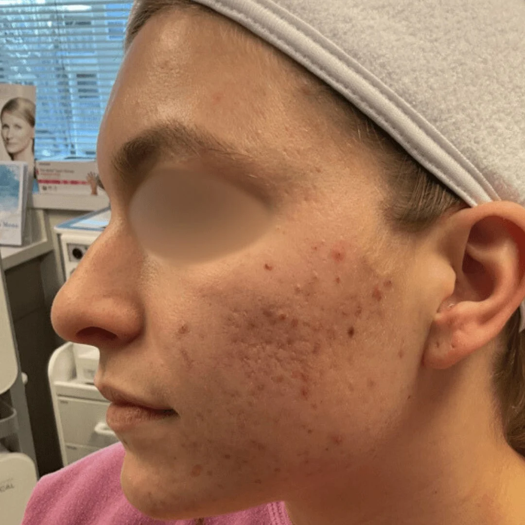 Acne Treatment 