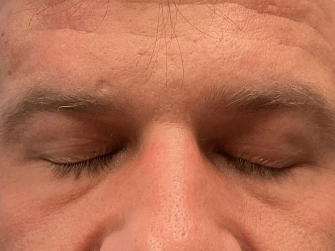 Blepharoplasty