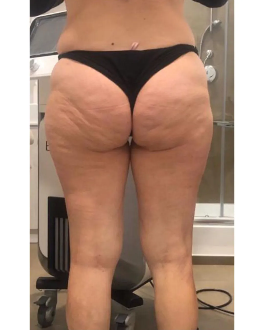 Cellulite Reduction