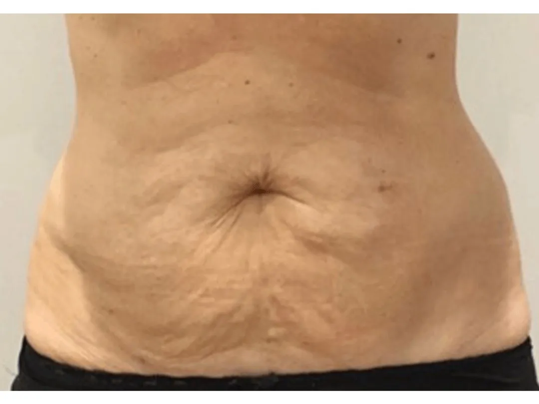 Body Contouring