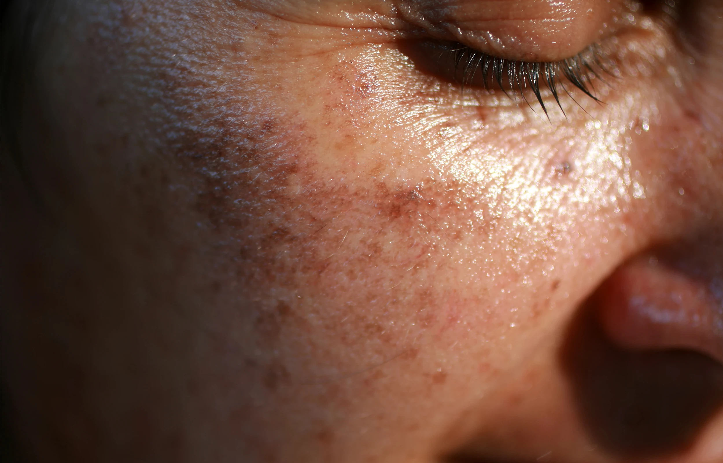 Dye-VL Photofacials