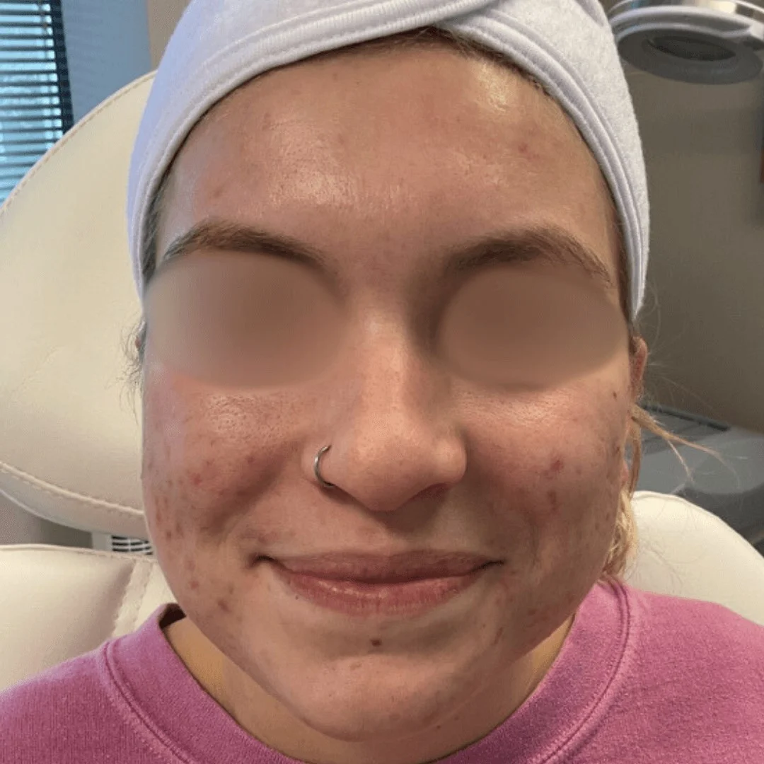 Acne Treatment 