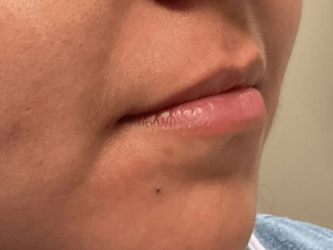 Lip Filler