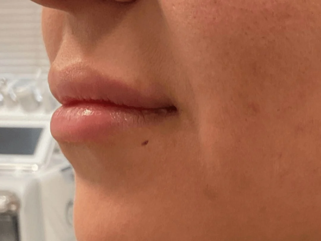 Lip Filler