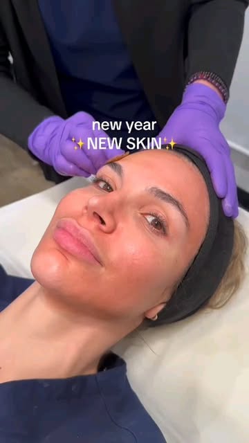 ✨️Peel in the New Year✨️  VI Peel - the #1 selling chemical peel - now availa...