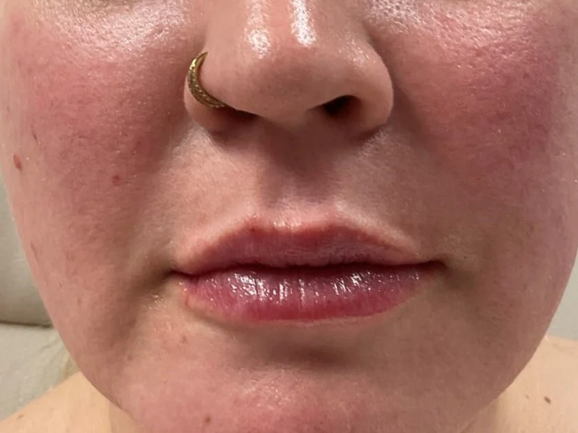  Lip Filler