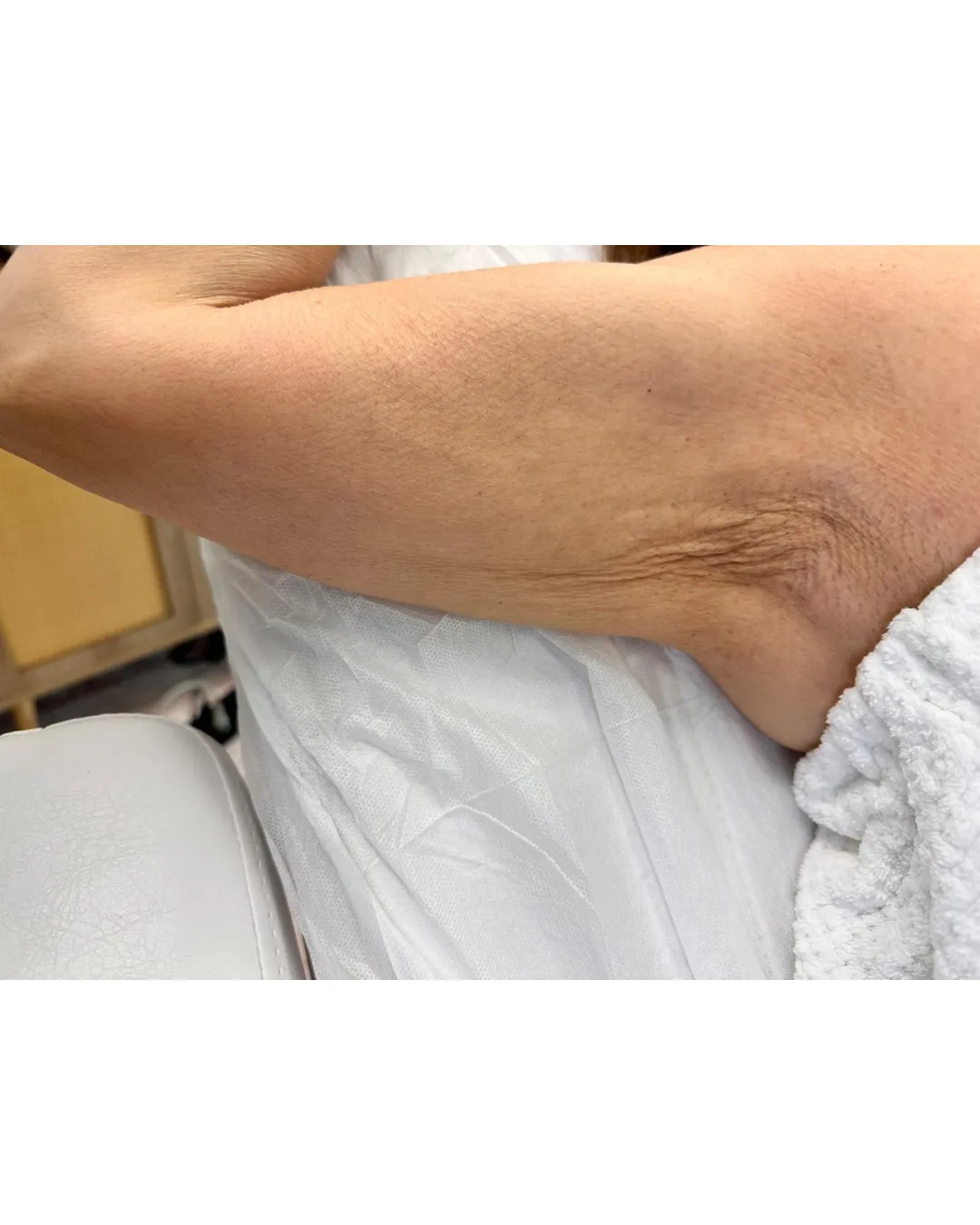 Arm Skin