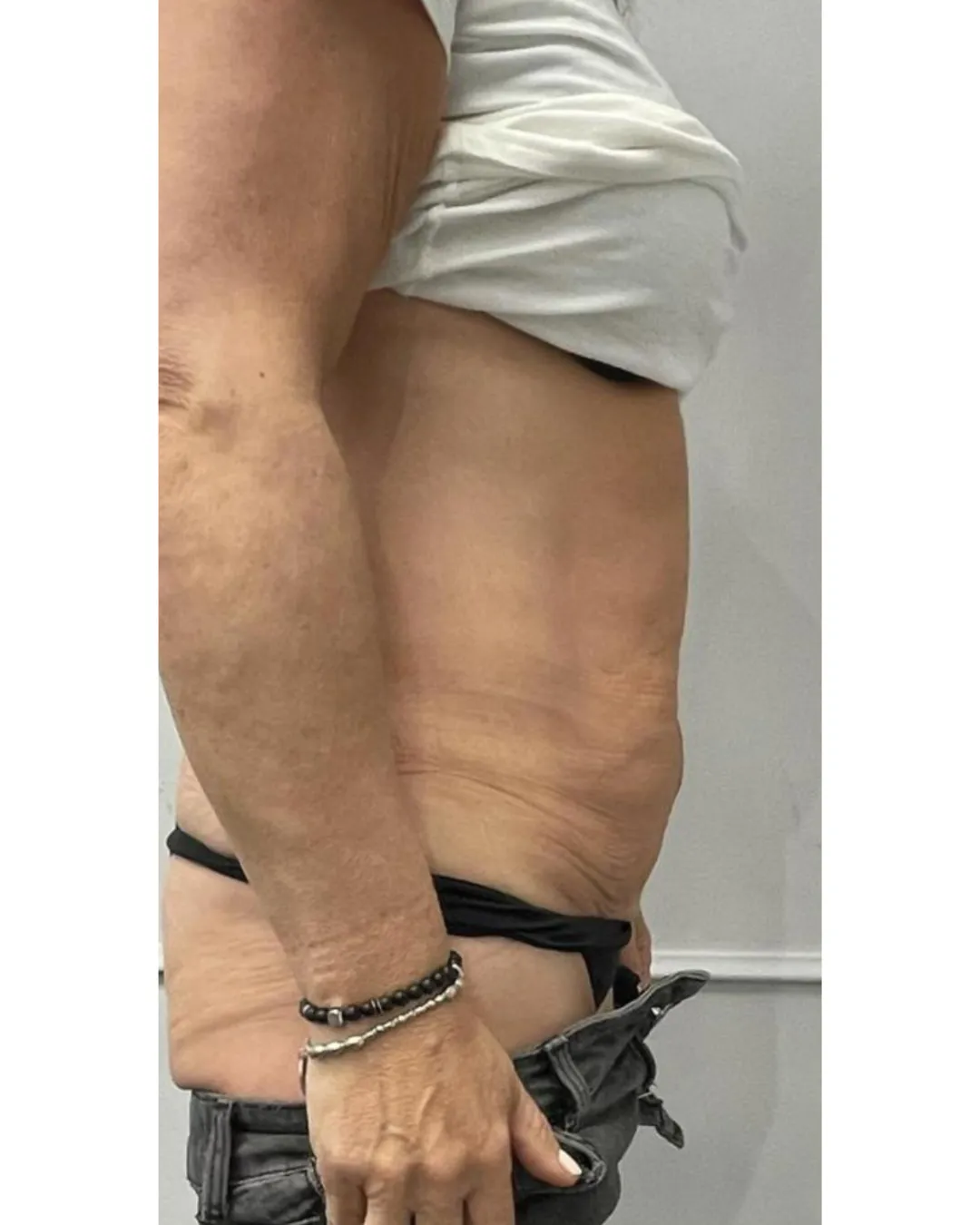 Skin Tightening