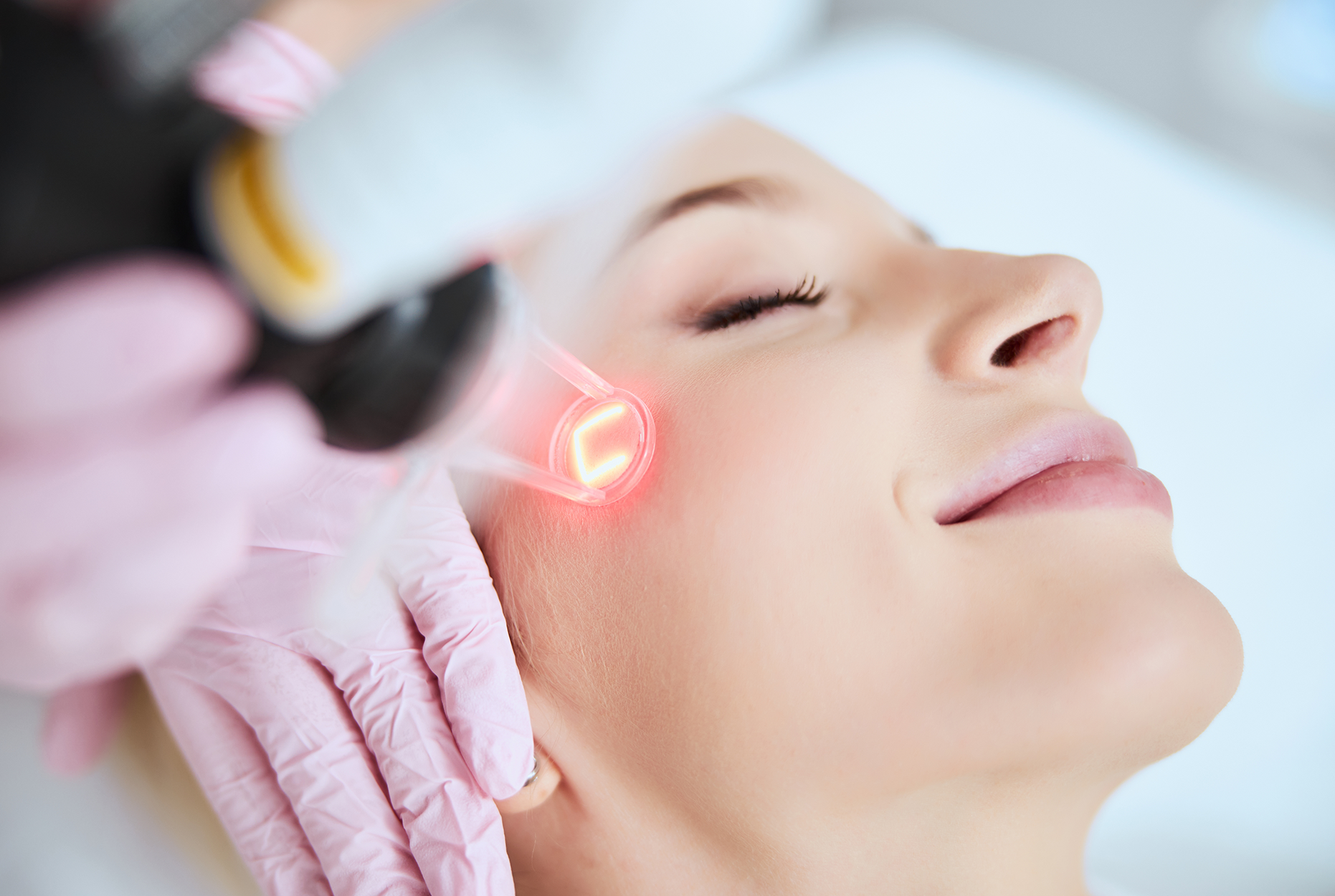 RF Microneedling