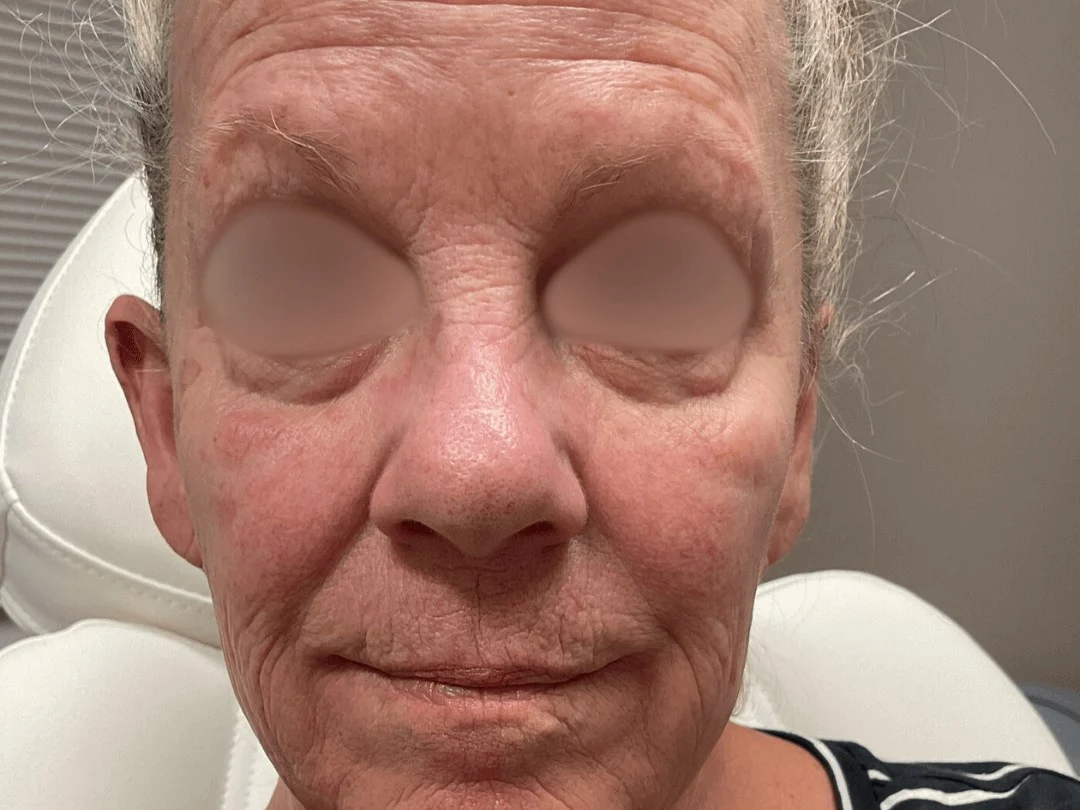 Skin Resurfacing