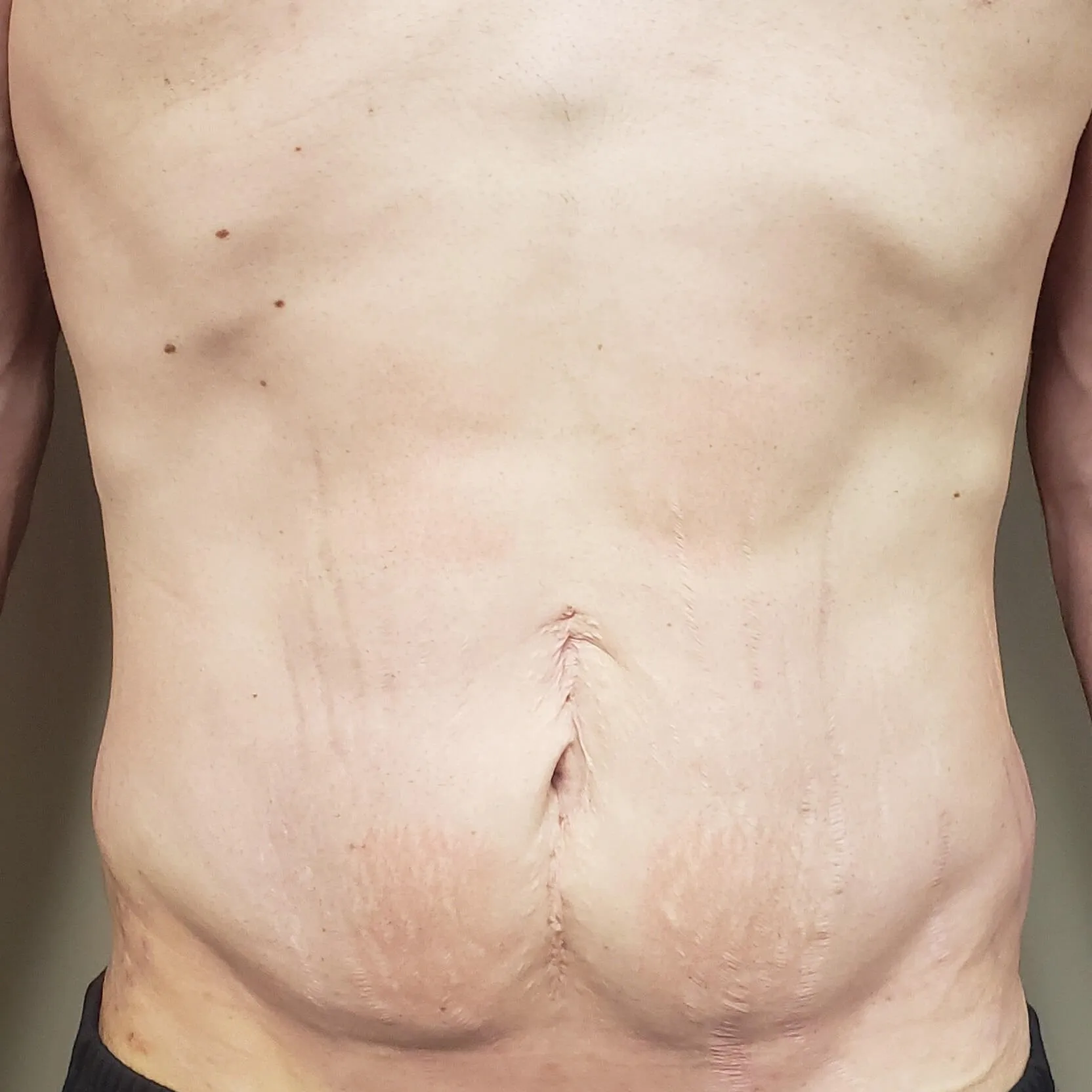 Body Contouring