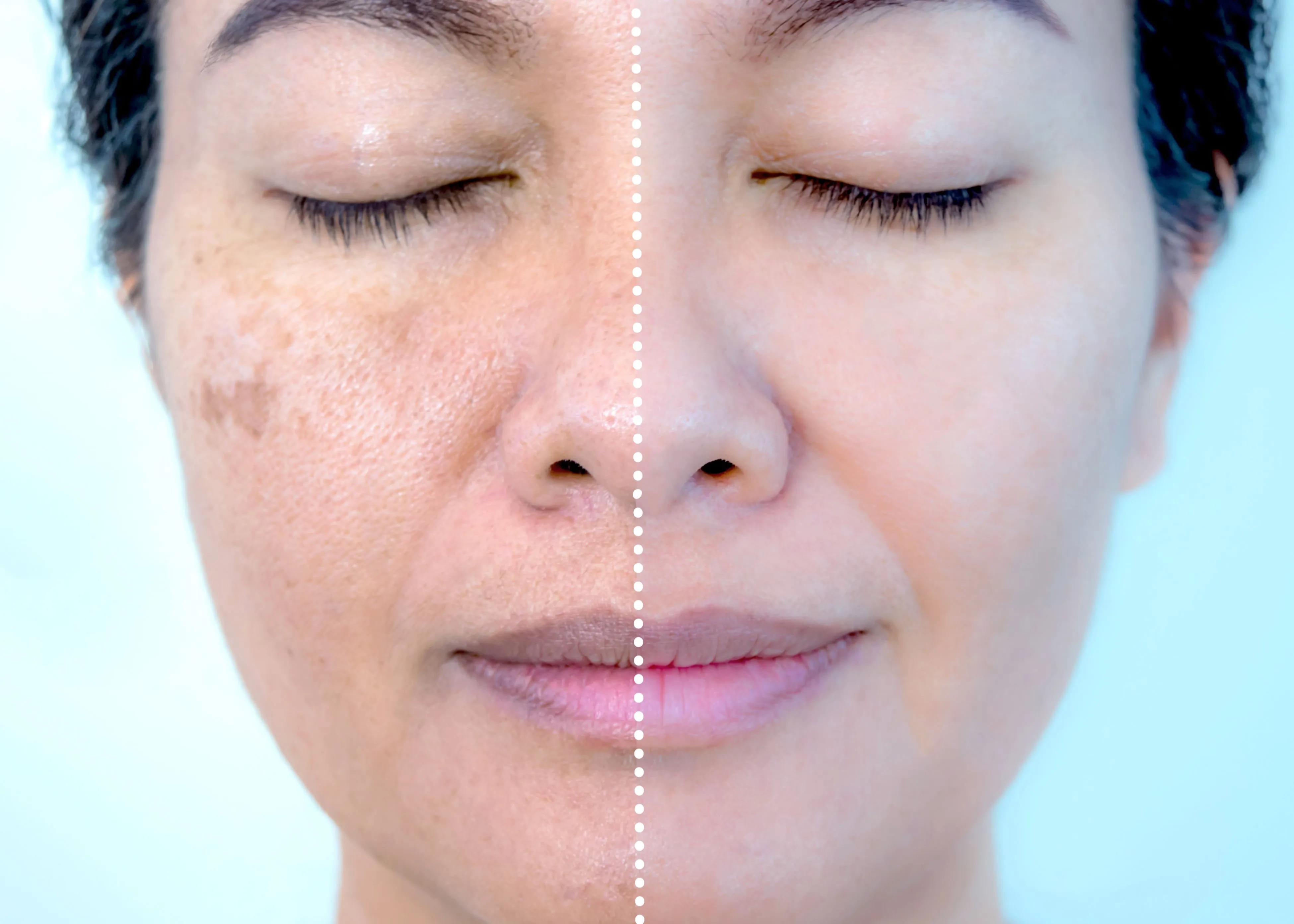 Dye-VL Photofacials