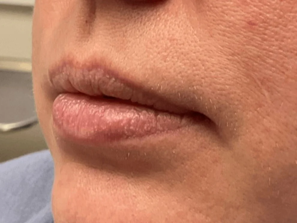 Lip Filler