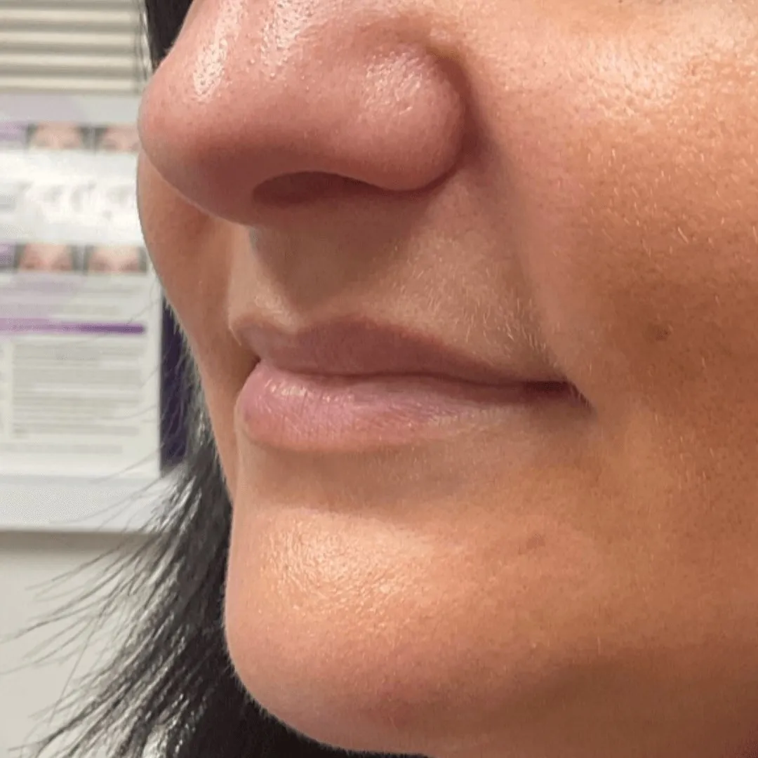  Lip Filler
