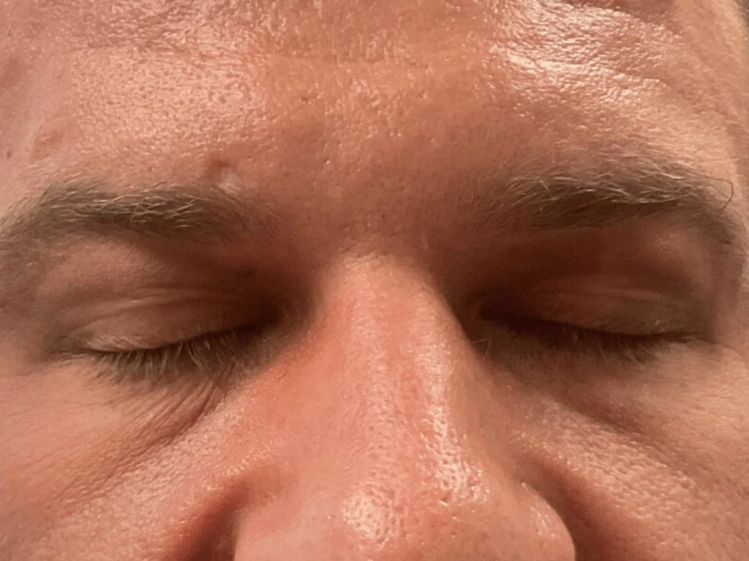 Blepharoplasty