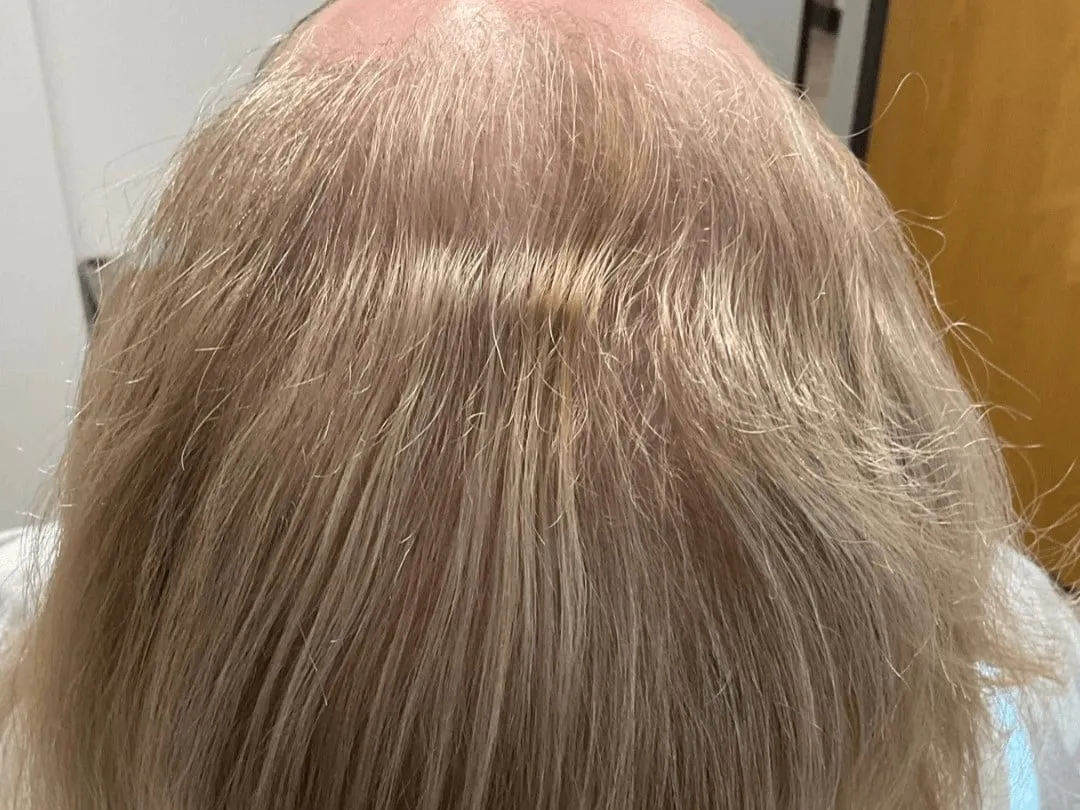 Hair Loss