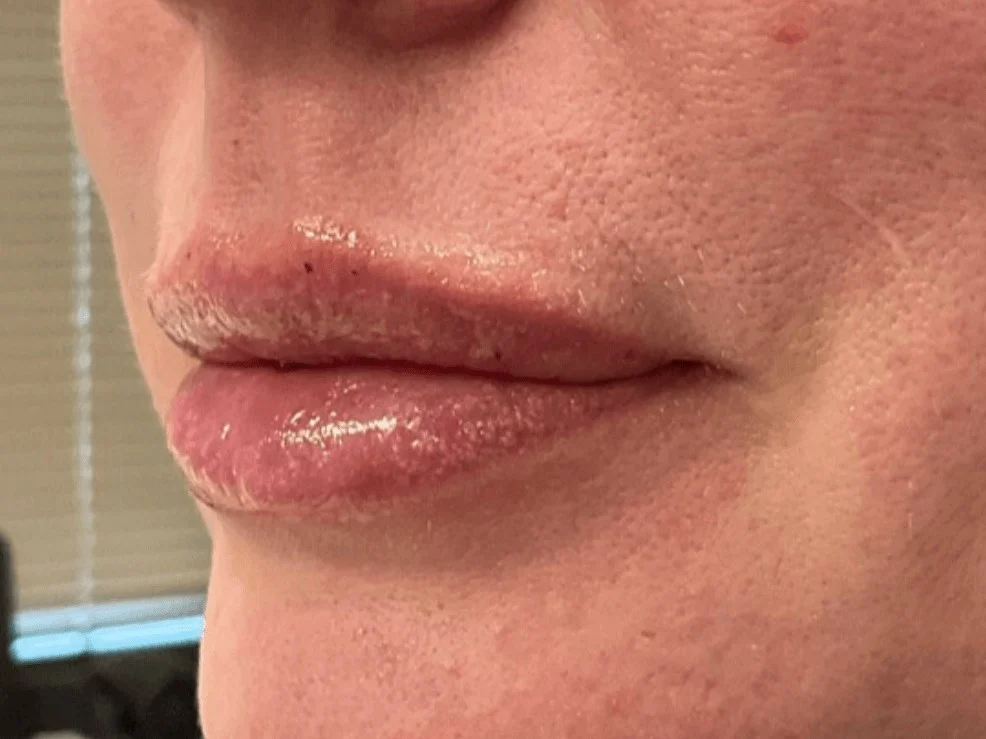 Lip Filler