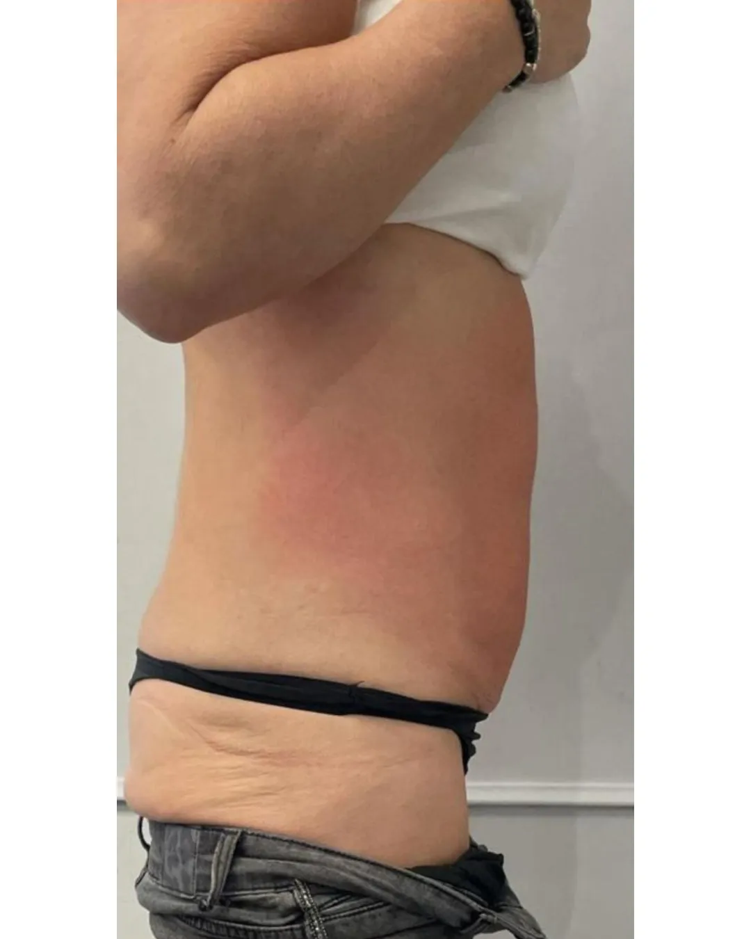 Skin Tightening